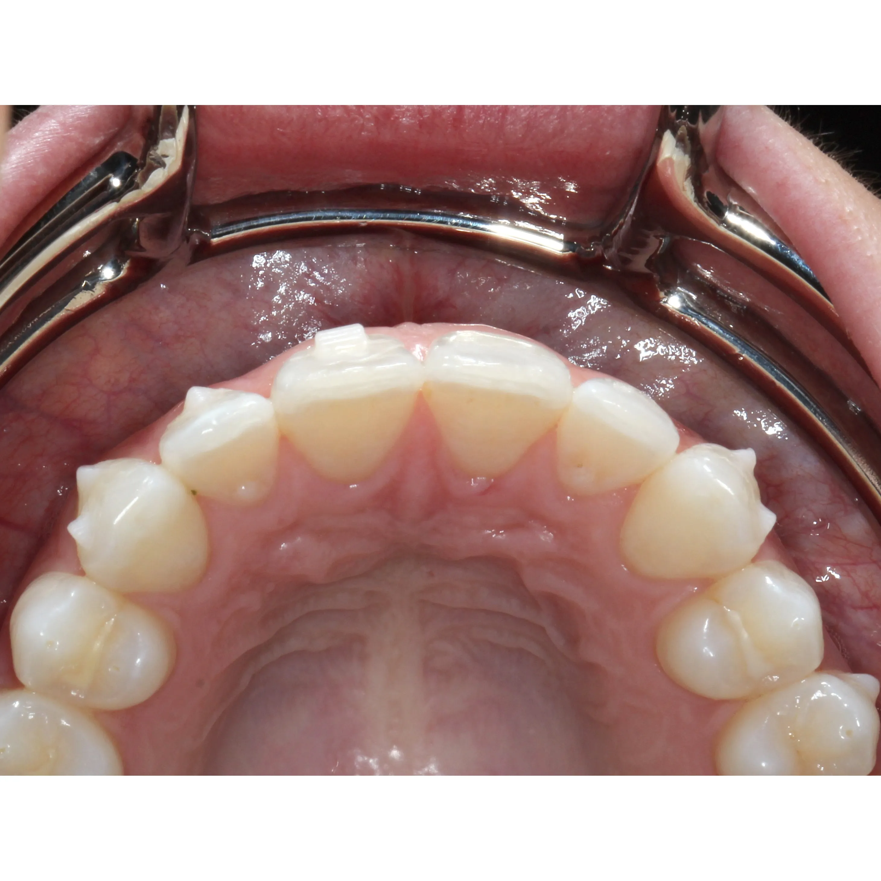 Stainless Steel Lip Retractor 1, 10, 20 Packs