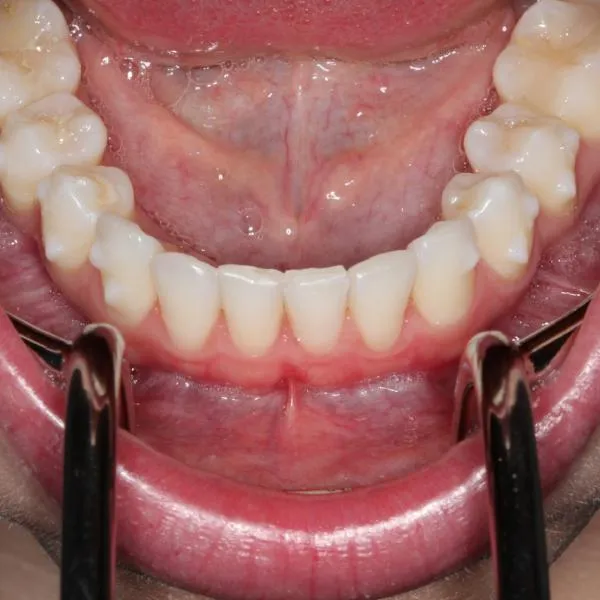 Stainless Steel Lip Retractor 1, 10, 20 Packs